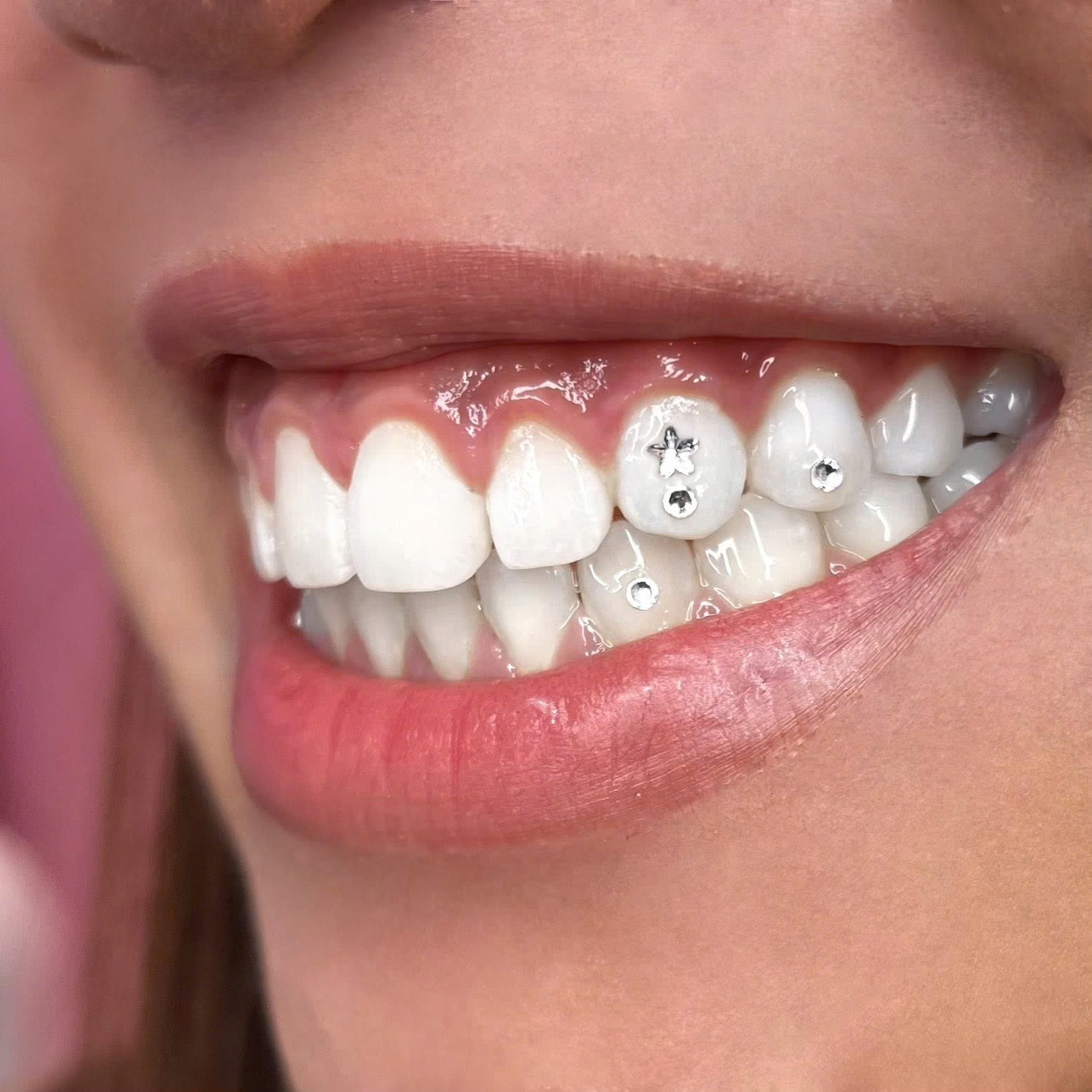 Tooth Gems Buffet: Sparkle Your Smile in Hanoi