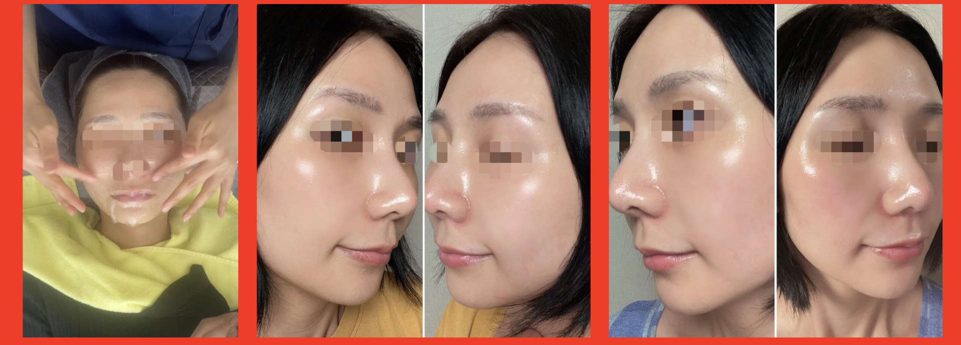 女士專屬除毛&換膚美容體驗 moremore clinical salon (東京澀谷)