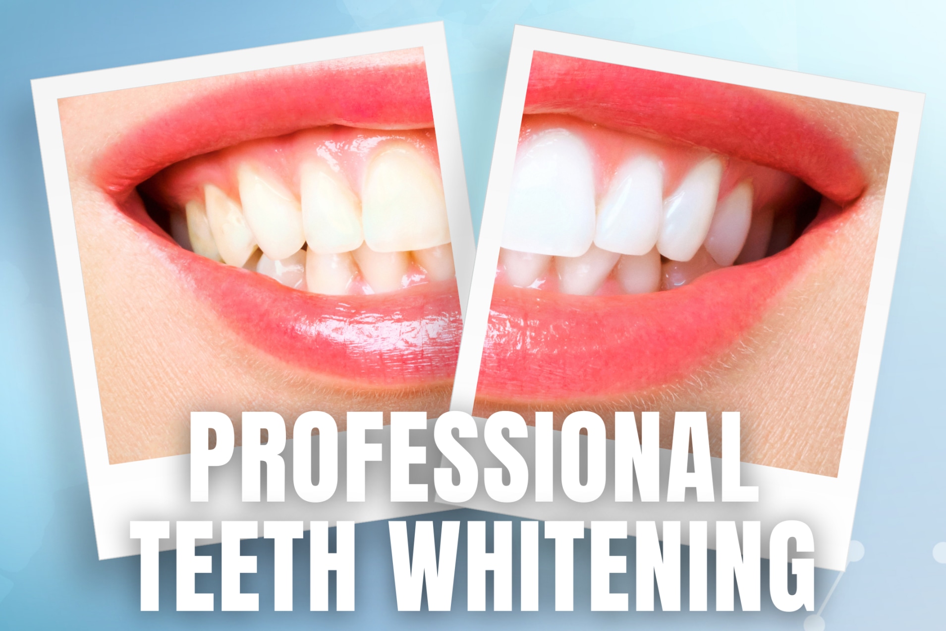 iSmile Professional Teeth Whitening Experience in Batam
