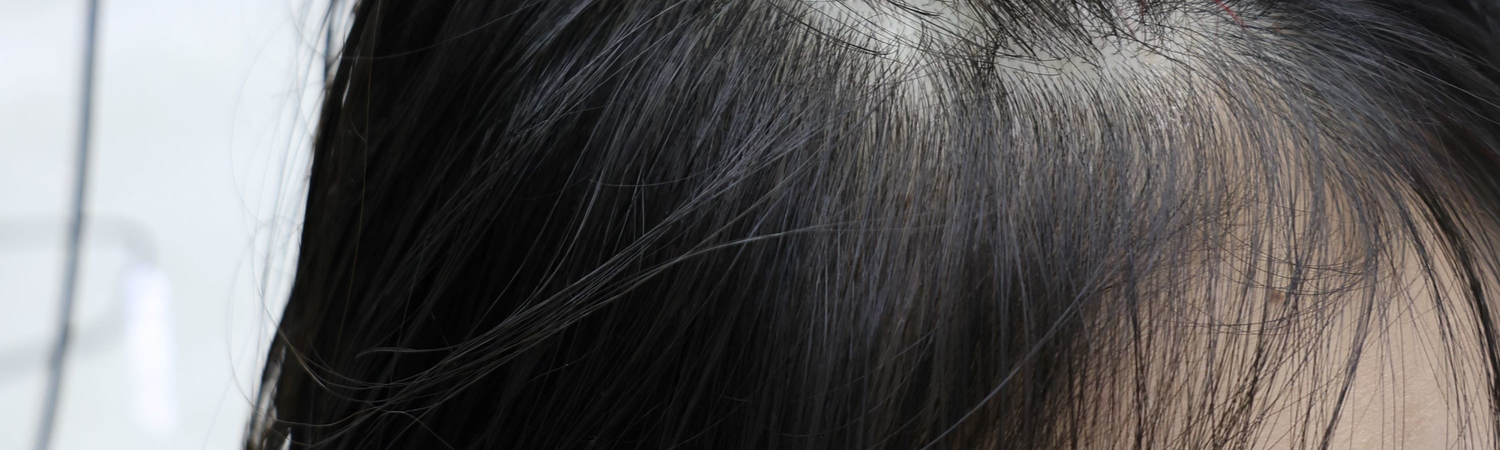 頭皮光線治療 & 頭皮細胞再生