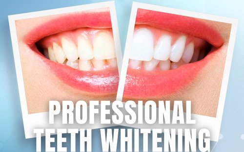 Esperienza di sbiancamento dentale professionale iSmile a Batam